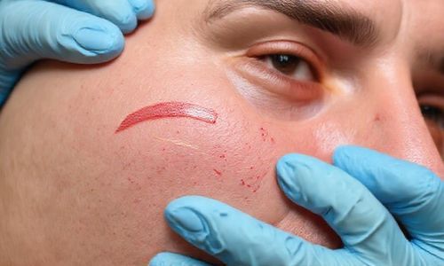 重度划痕， 专业处理